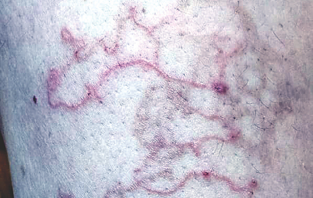 झुंझुनूं की महिला को मिली अजीब त्वचा बीमारी का इलाज