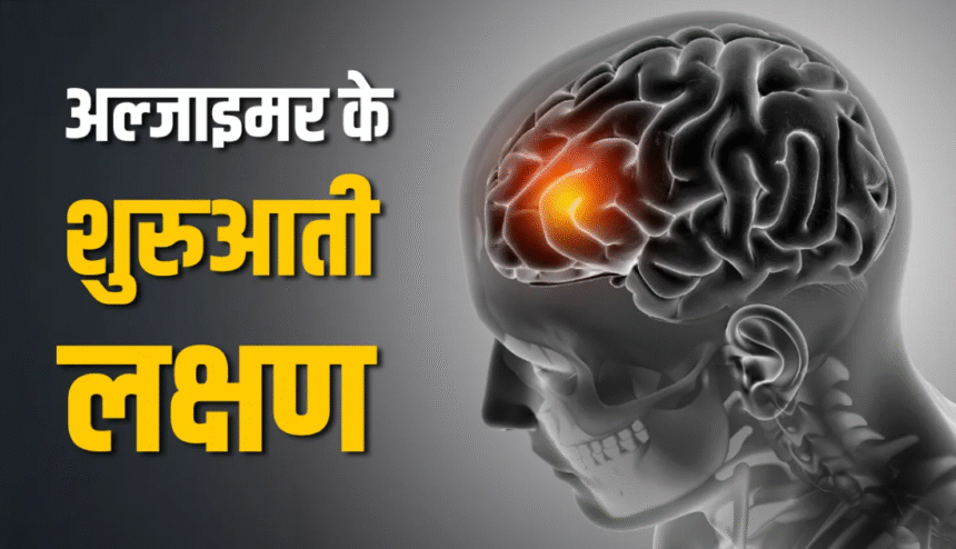 अल्जाइमर रोग के लक्षणों के बारे में जानें अल्जाइमर रोग के लक्षणों के बारे में जानें