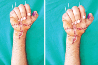 जोधपुर एम्स में युवक के कटे हाथों का सफल ऑपरेशन